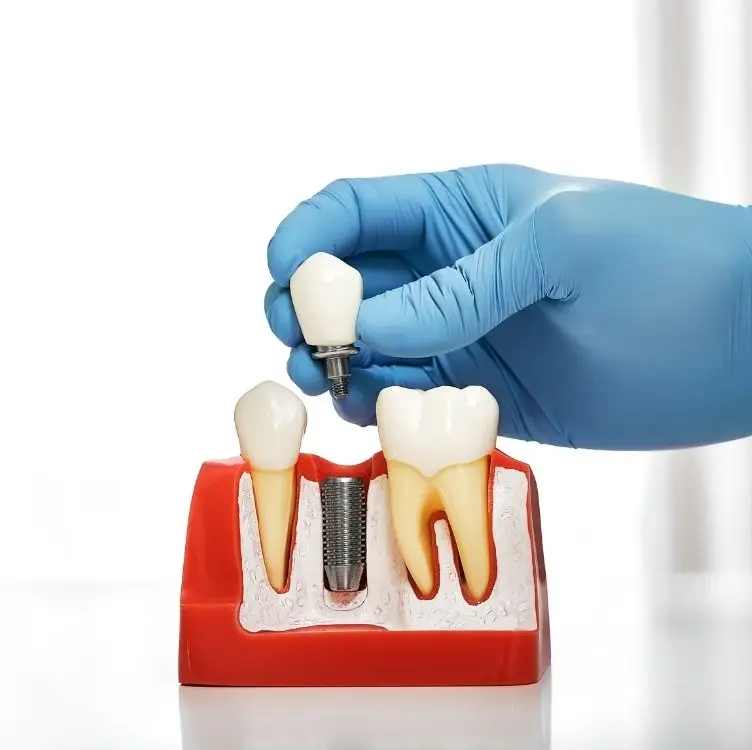 Dantų implantai