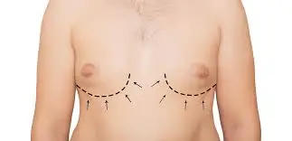 Ginekomastijos operacija : plokščia krūtinė Turkijoje