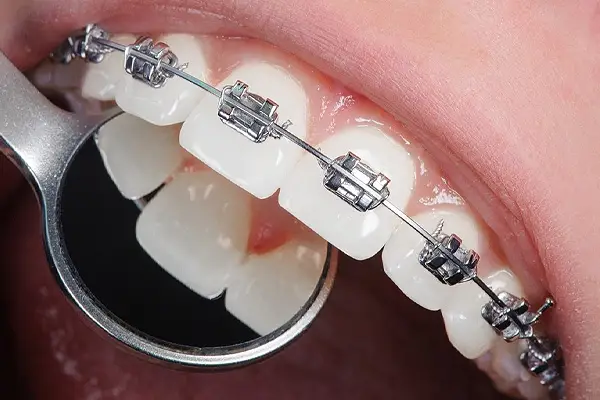 Ortodontinis gydymas – tiesi šypsena Turkijoje