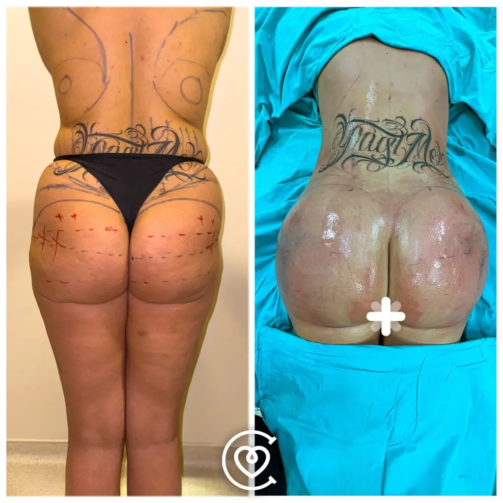 Pacientų transformacijos BBL