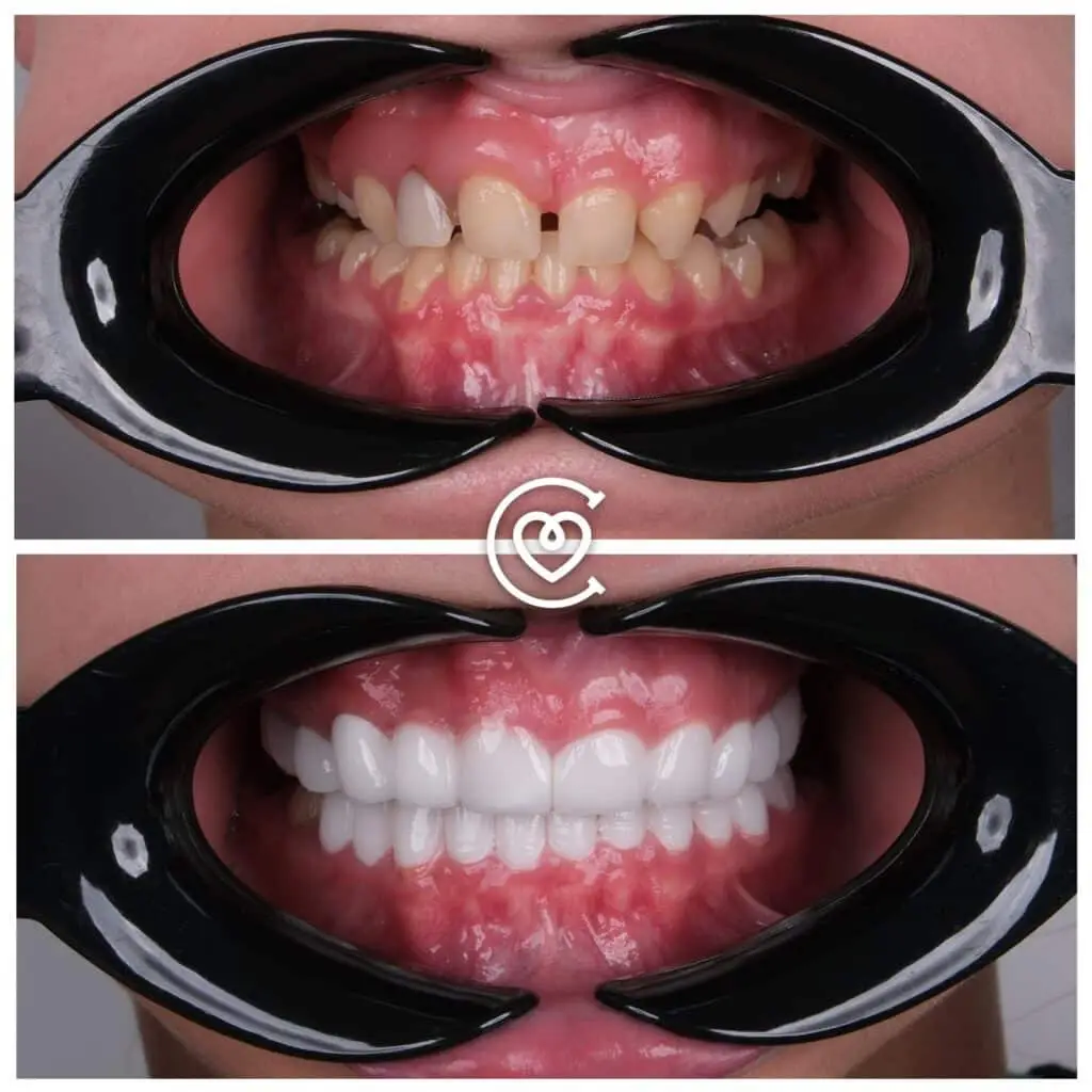 Dantų gydymas prieš po nuotrauka