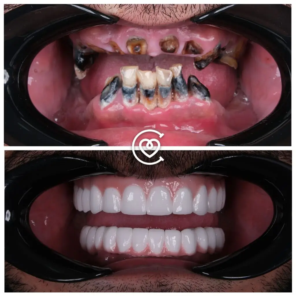 Dantų gydymas prieš po nuotrauka