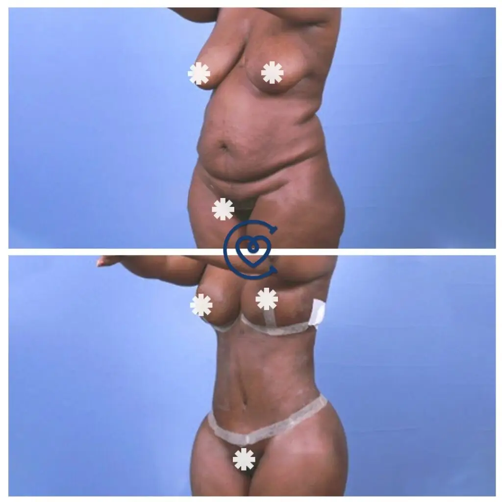 Estetinė chirurgija prieš po nuotrauka