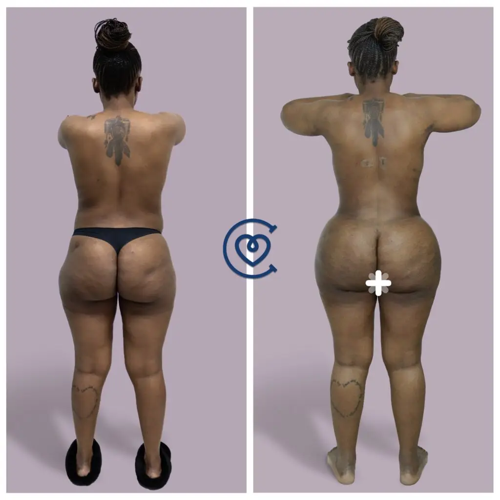 Liposakcija prieš po nuotrauka