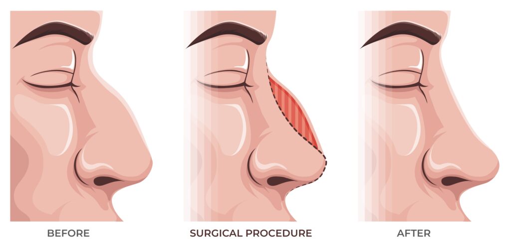 nosies operaciją rinoplastikoje pasaulyje