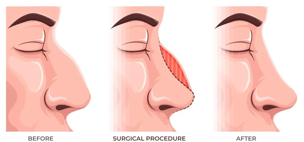 nosies operaciją rinoplastikoje pasaulyje