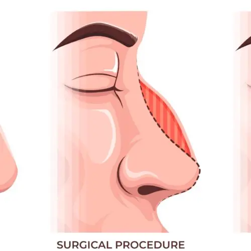 nosies operaciją rinoplastikoje pasaulyje