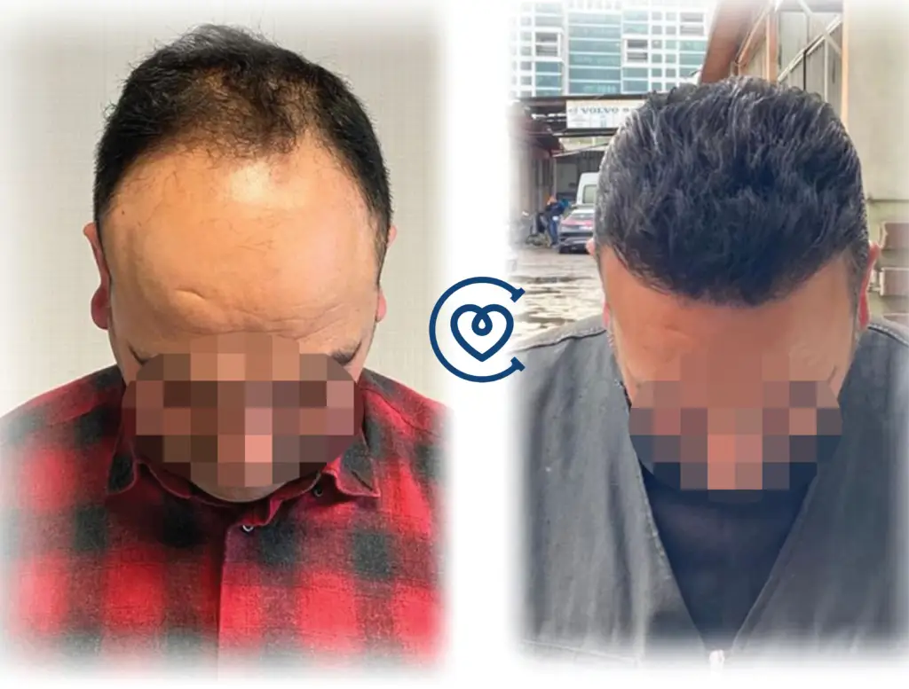 Plaukų persodinimas prieš po nuotrauka