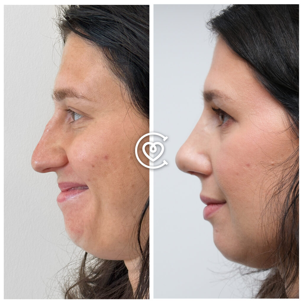 Rinoplastika prieš po nuotrauka