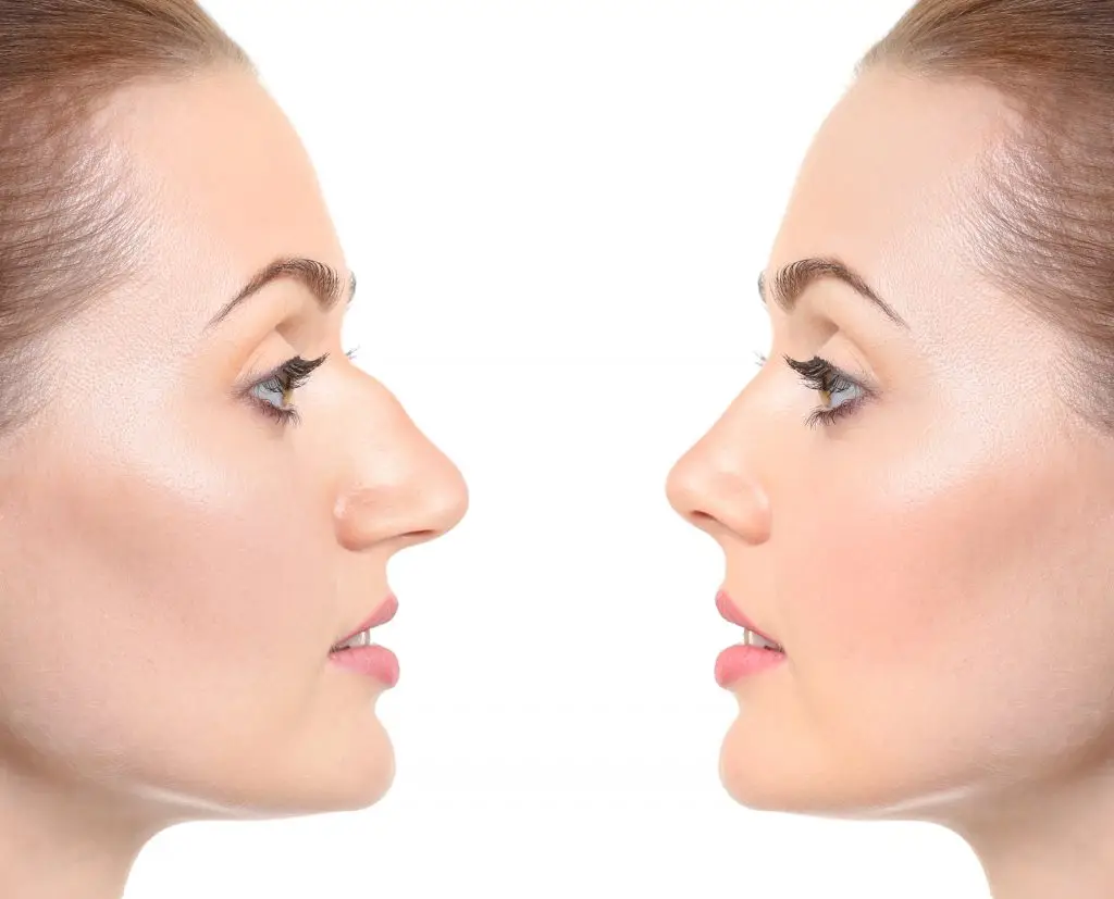 Alarplastika vs. Rinoplastika