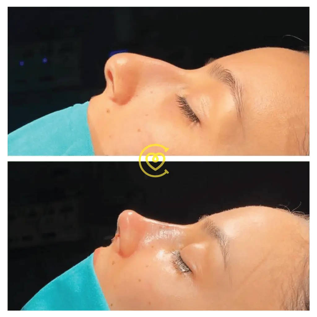 Alarplasty vs. Rhinoplasty: Which Surgery Is Right for You?