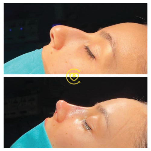 Alarplastika vs. Rinoplastika