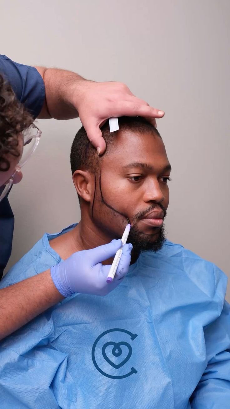 Profesionaliai atliekamas barzdos persodinimas (Beard Transplant) „Cayra Clinic“ plaukų transplantacijos centre Turkijoje