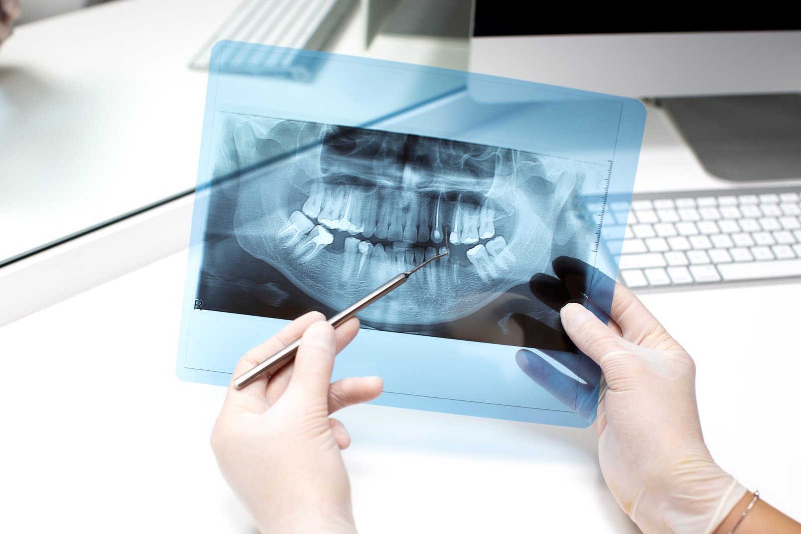 Dantų implantacija ir kaulo plastika Antalijos odontologijos klinikoje