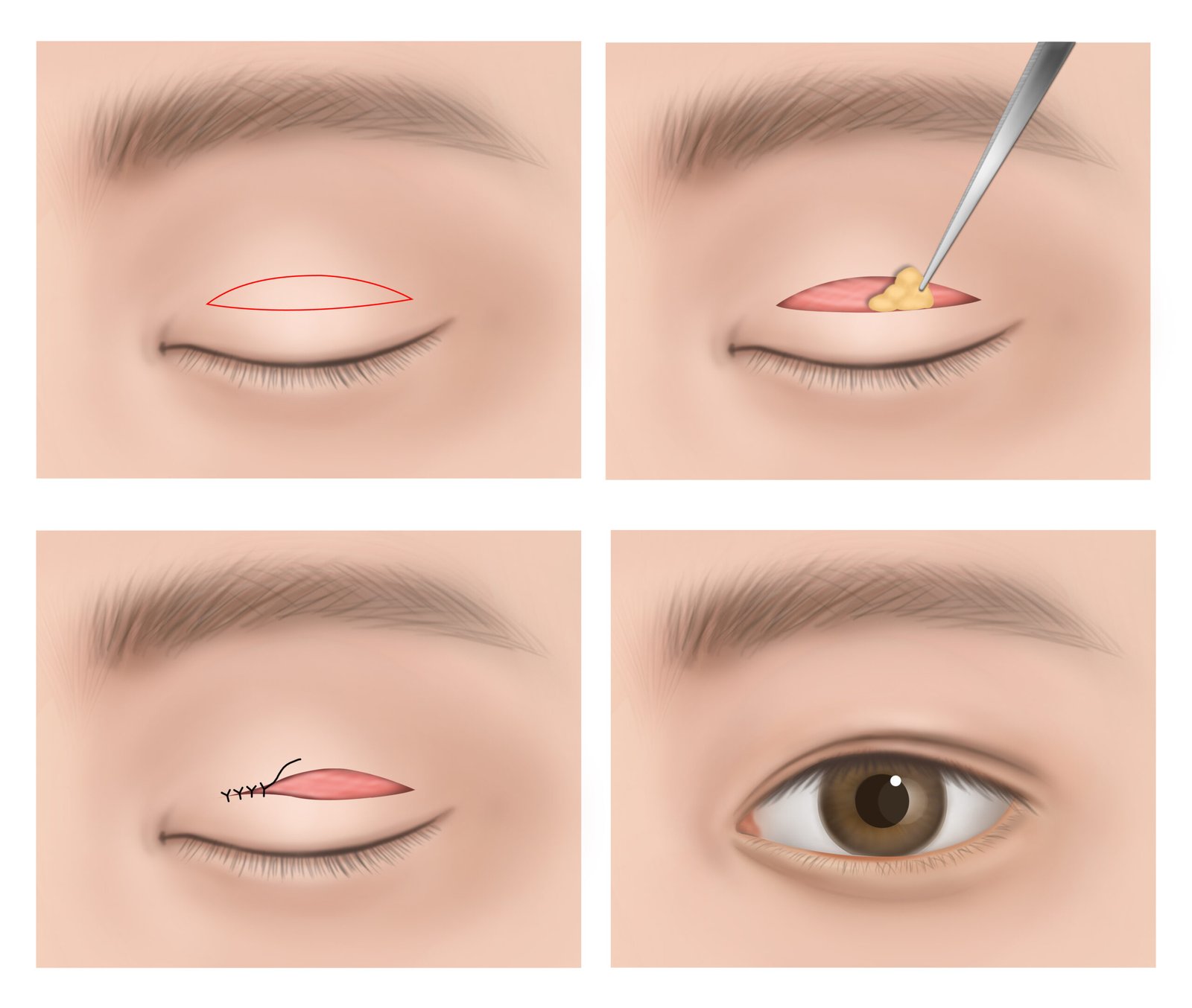 Profesionaliai atliekama viršutinių vokų plastika (blefaroplastika) „Cayra Clinic“ Turkijoje