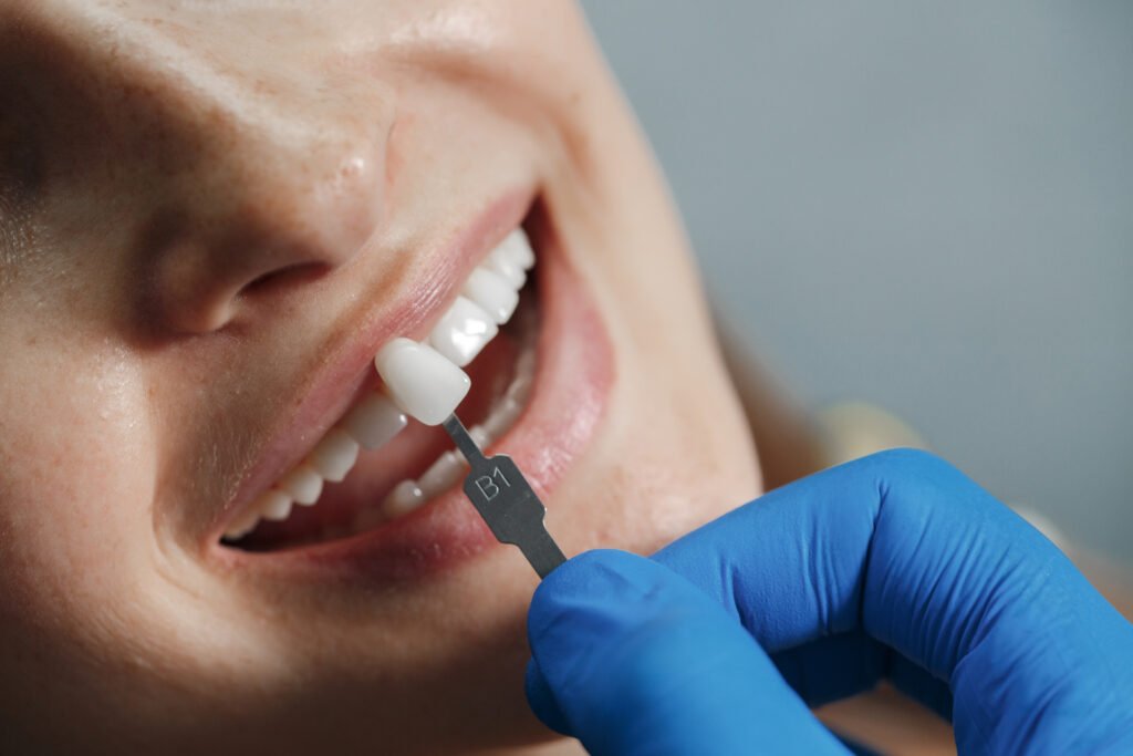 Struttura anatomica e spessore differente tra faccette estetiche e corone totali