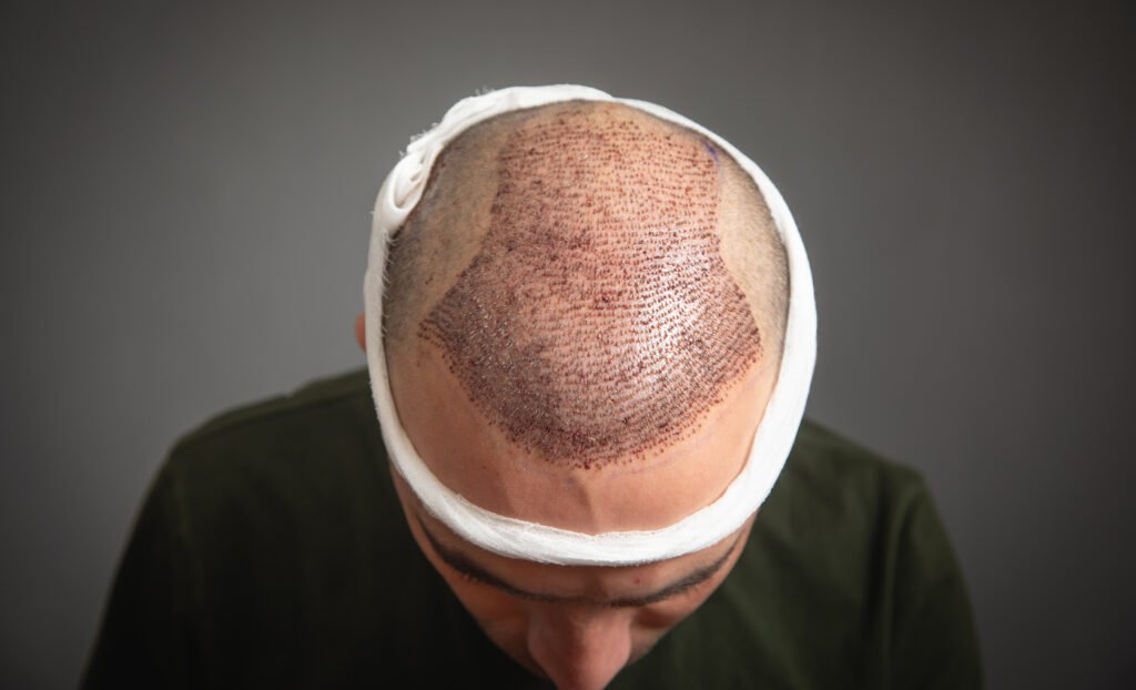 Analisi visiva delle tempistiche di guarigione e della caduta temporanea post operatoria