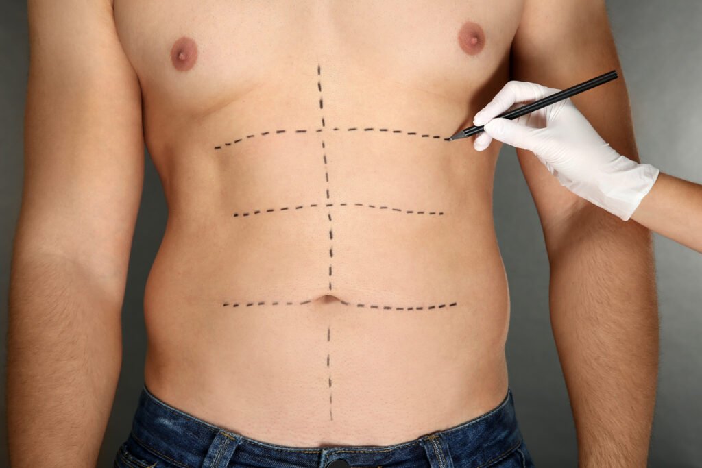 Tecnologia avanzata di liposuzione VASER utilizzata per il rimodellamento