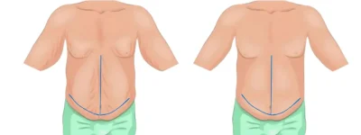 Fleur-de-Lis-Tummy-tuck-photo-scar.webp